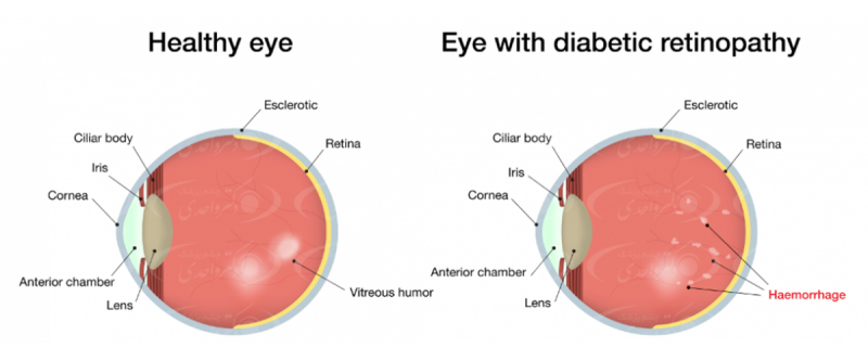 عوارض دیابت بر روی چشم یا رتینوپاتی دیابتی