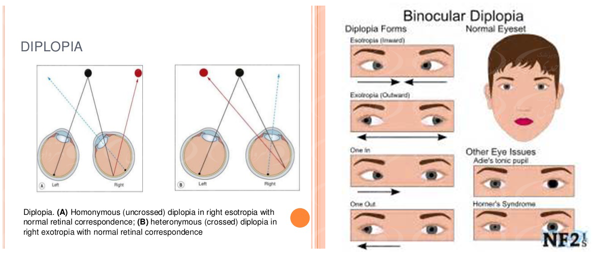 علت بیماری دوبینی چشم و روش درمان آن Diplopia