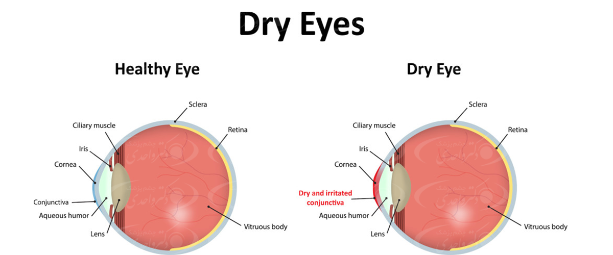 علت خشکی چشم و روش درمان آن