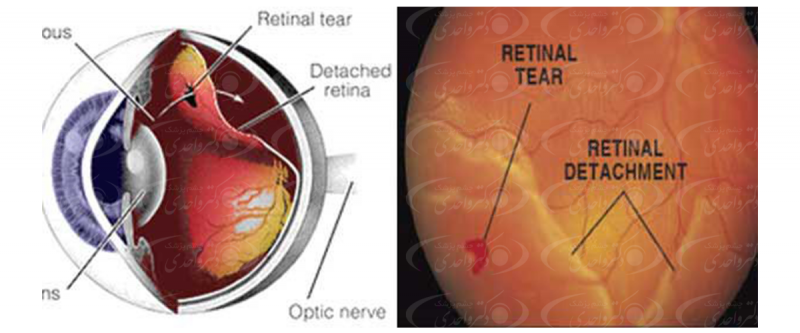 علت مهم پارگی شبکیه چشم و روش درمان