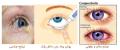 عفونت ملتحمه چشم و روش درمان قرمزی چشم