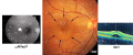 بیماری چشمی csr و روش درمان آن